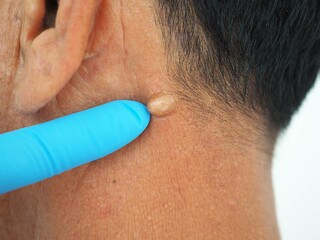 Man pointed to sebaceous cysts on his neck, formed by sebaceous glands. Oils called sebum and laser skin treatments or flea biopsies health concept. closeup photo, blurred.