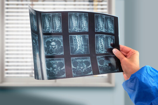 A doctor hands holding and analyzes spine radiography X-ray
