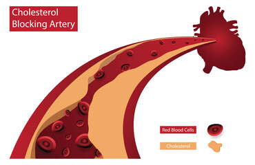 illustration of medical and hematology, Cholesterol Blocking Artery, Cholesterol and Artery Plaque Buildup, High blood pressure, fat, cholesterol and other substances build up in the walls of arteries