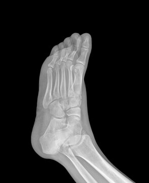 X ray of skeleton of foot. Human foot bones. Anatomy of joints. Foot Radiography with a fracture in the second metatarsal.