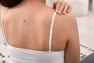 Closeup of woman`s body with birthmarks indoors, back view
