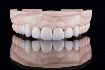 Quality dental prosthesis made of titanium beam and ceramics for fixation to the upper jaw. Teeth...
