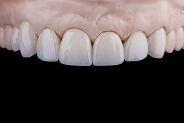Quality dental prosthesis made of titanium beam and ceramics for fixation to the upper jaw. Teeth treatment.