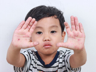 sick child raising both hands pain with hand, foot and mouth disease viral