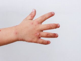red rash on baby hands Hand-foot-and-mouth disease HFMD