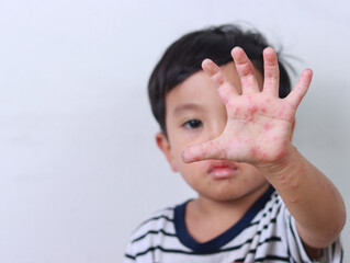Boy suffering from hand, foot and mouth disease showing hand with rash - obrazy, fototapety, plakaty