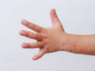 Hand-foot-and-mouth disease HFMD human hand of scarlet fever on palm enterovirus