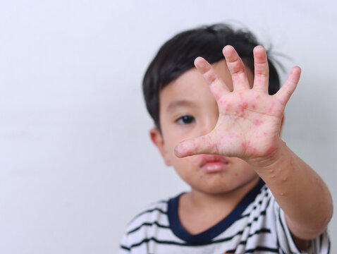 Boy suffering from hand, foot and mouth disease showing hand with rash