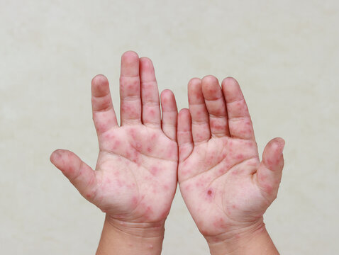HFMD Rash and red blisters on the body of a child