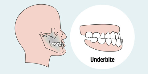 Tooth problem. Side view man with misaligned teeth. Malocclusion