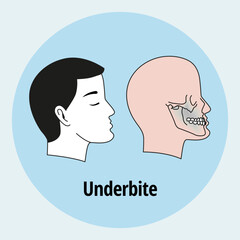 Tooth problem. Side view man with misaligned teeth. Malocclusion