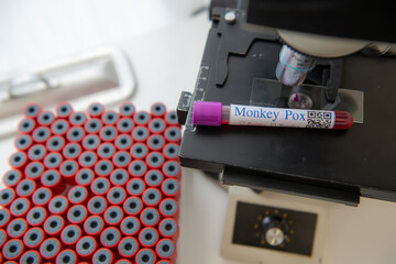 Blood sample tube for Monkeypox virus test. It is also known as the Moneypox virus, is a double-stranded DNA, zoonotic virus and a species of the genus Orthopoxvirus in the family Poxviridae