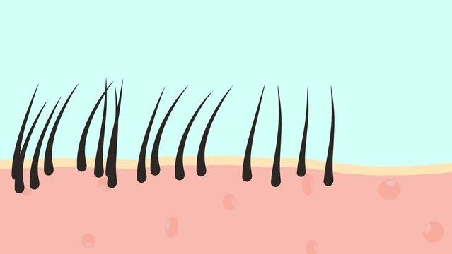 Skin cross section of pore types. Normal, oily, and dry pores. Pale colored illustration in flat cartoon style. cartoon skin with hair