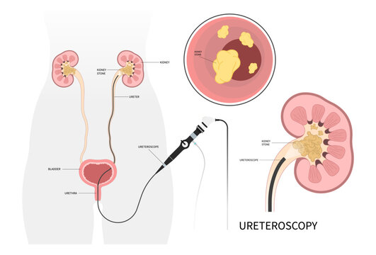 Blood in urine biopsy for Kidney stone removal uric acid Blocked ureter Painful treatment Shockwave uropathy cyst pelvis urinating bleeding catheter urologist ureteric tumor