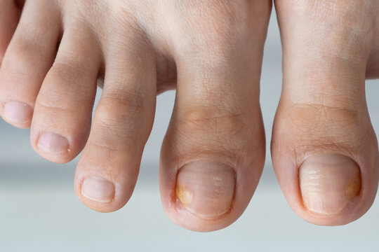 person feet close up, fungus, broken nail, skin infection, toe mycosis, treatment needed, fungal infection concept, onychomycosis, onycholysis, nail separates from nail bed, separated 