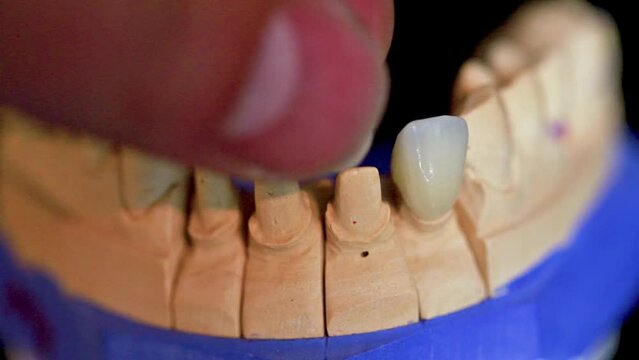 plaster model of the jaw with four zirconia dental crowns on a black background. Dental technician puts crowns on the jaw model