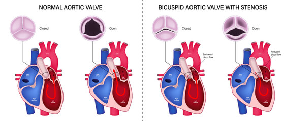 The difference of normal aortic valve and bicuspid aortic valve with stenosis. Valvular aortic stenosis. Heart anatomy vector. Close-up of normal and abnormal aortic valves.
