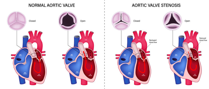 The difference of normal aortic valve and aortic valve stenosis. Valvular aortic stenosis. Heart anatomy vector. Close-up of normal and abnormal aortic valves.