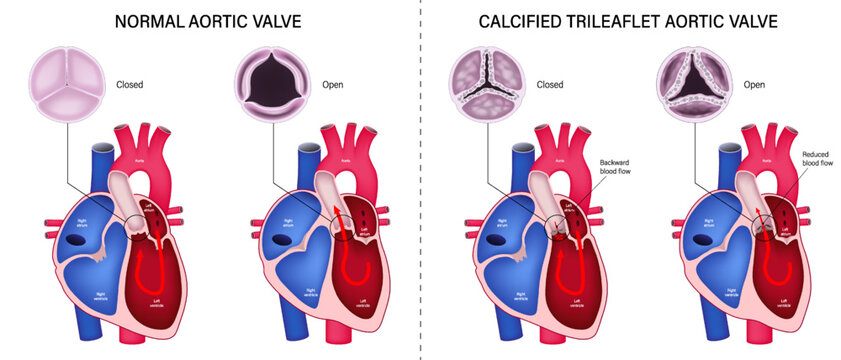 The difference of normal aortic valve and calcified trileaflet aortic valve. Valvular aortic stenosis. Heart anatomy vector. Close-up of normal and abnormal aortic valves.