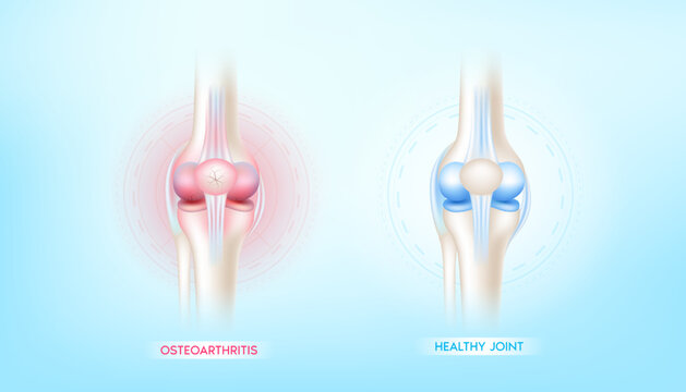 Arthritis Knee Joint In Leg And Bone Healthy. Human Bone Anatomy Damage Treatment Osteoarthritis. Skeleton X Ray Scan Concept. Vector EPS10 Illustration.