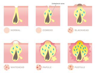 Types of acne. Comedo, blackhead, whitehead, papule, pustule. Vector illustration in flat cartoon style isolated on white background.