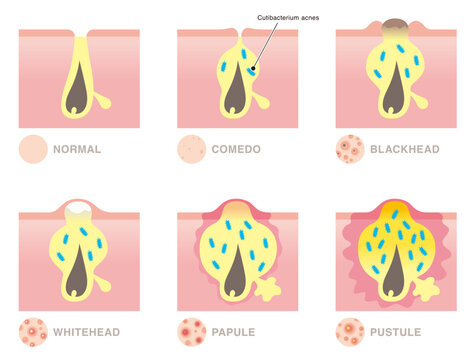 Types of acne. Comedo, blackhead, whitehead, papule, pustule. Vector illustration in flat cartoon style isolated on white background.