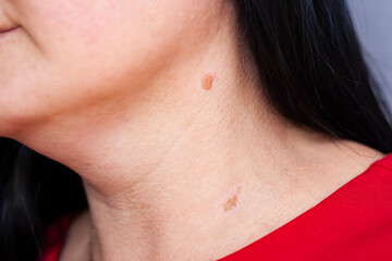 Girl with birthmarks on the neck