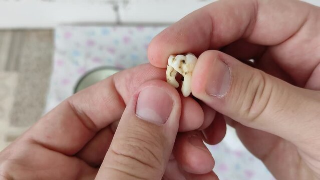 Dentist shows the removed and sawn tooth molar. Complicated tooth extraction. Close-up video