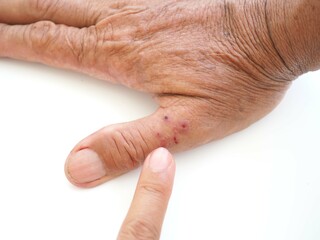 Red spots on men's fingers are caused by insect bites. Closeup photo, blurred.