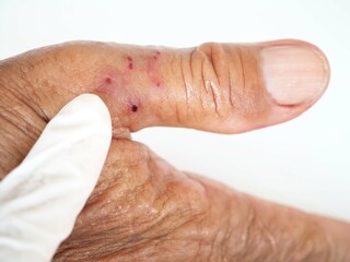 Red spots on men's fingers are caused by insect bites. Closeup photo, blurred.