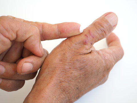 Elderly man is applying a finger cream to the area of ​​insect bites. Closeup photo, blurred.