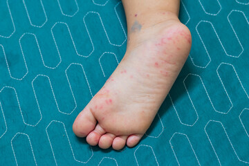 Enterovirus Leg arm mouth Rash on the body of a child Cocksackie virus.Hand foot and mouth disease It is an epidemic in young children and during the rainy season.