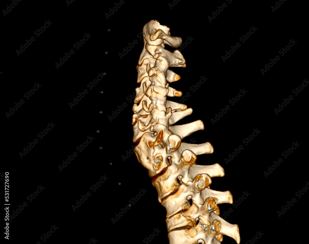 Poster ct scan of cervical spine ( c-spine ) 3d rendering image .