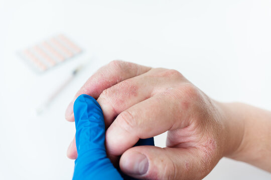 A Man Shows A Reddened Rash On His Hands To The Doctor. Causes Of Itchy Skin Can Be Dermatitis (eczema), Dry Skin, Burns, Food Allergies. Healthcare Concept.