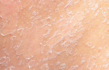 Sunburn, close-up of human skin. Flaky skin from allergies, peeling or eczema. Dry skin in need of treatment and hydration.