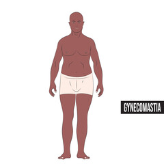 Fototapeta premium Gynecomastia is an increase in the amount of tissue in the mammary glands in boys or men.