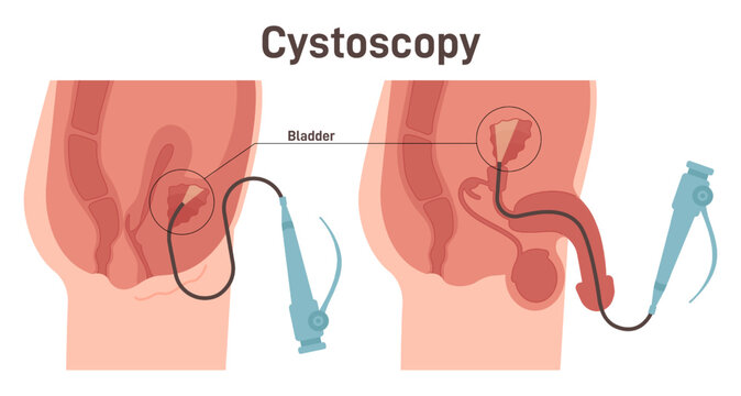 Cystoscopy set. Male and female bladder surface examination with a flexible