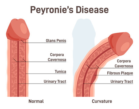 Peyronie's disease. Fibrous scar tissue developing under the skin of the penis