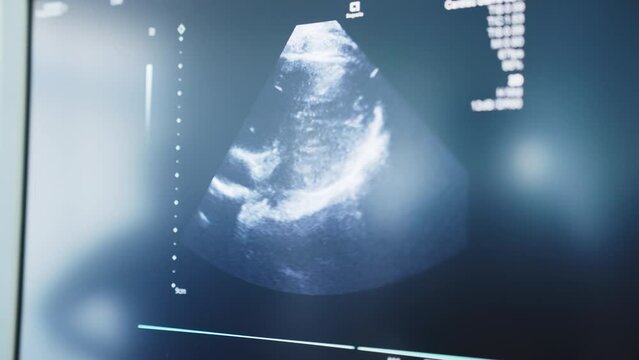 Modern Echocardiography Machine Screen Showing Ultrasound of Boys Heart