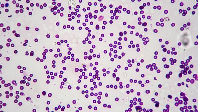 Smear of human blood under microscope with 400 times magnification on bright field. Erythrocytes and monocytes educated in medical lab. Studying hematology for helping people health. Immune system