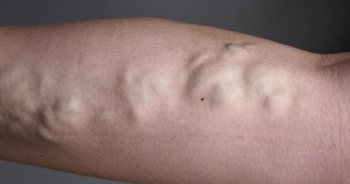 leg with varicose vein closeup. High quality 4k footage