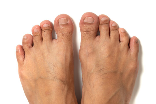 Close up of all the man toes with dry skin and the crack un-even toe nail