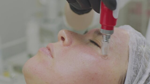 Close-up of a woman face. Needle mesotherapy procedure into the skin of the face