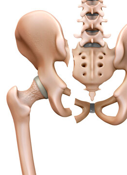 Fractured pelvis, illustration