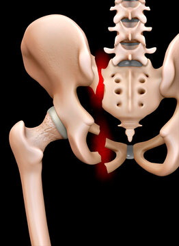 Fractured pelvis, illustration