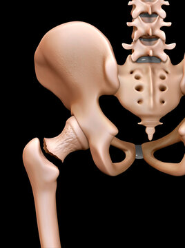 Fractured hip, illustration