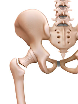 Femur fracture, illustration