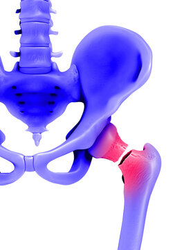 Femure fracture, illustration