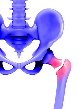 Femure fracture, illustration