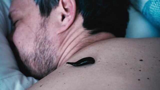 A leech sucks blood on the back of a patient in a hirudotherapy salon 